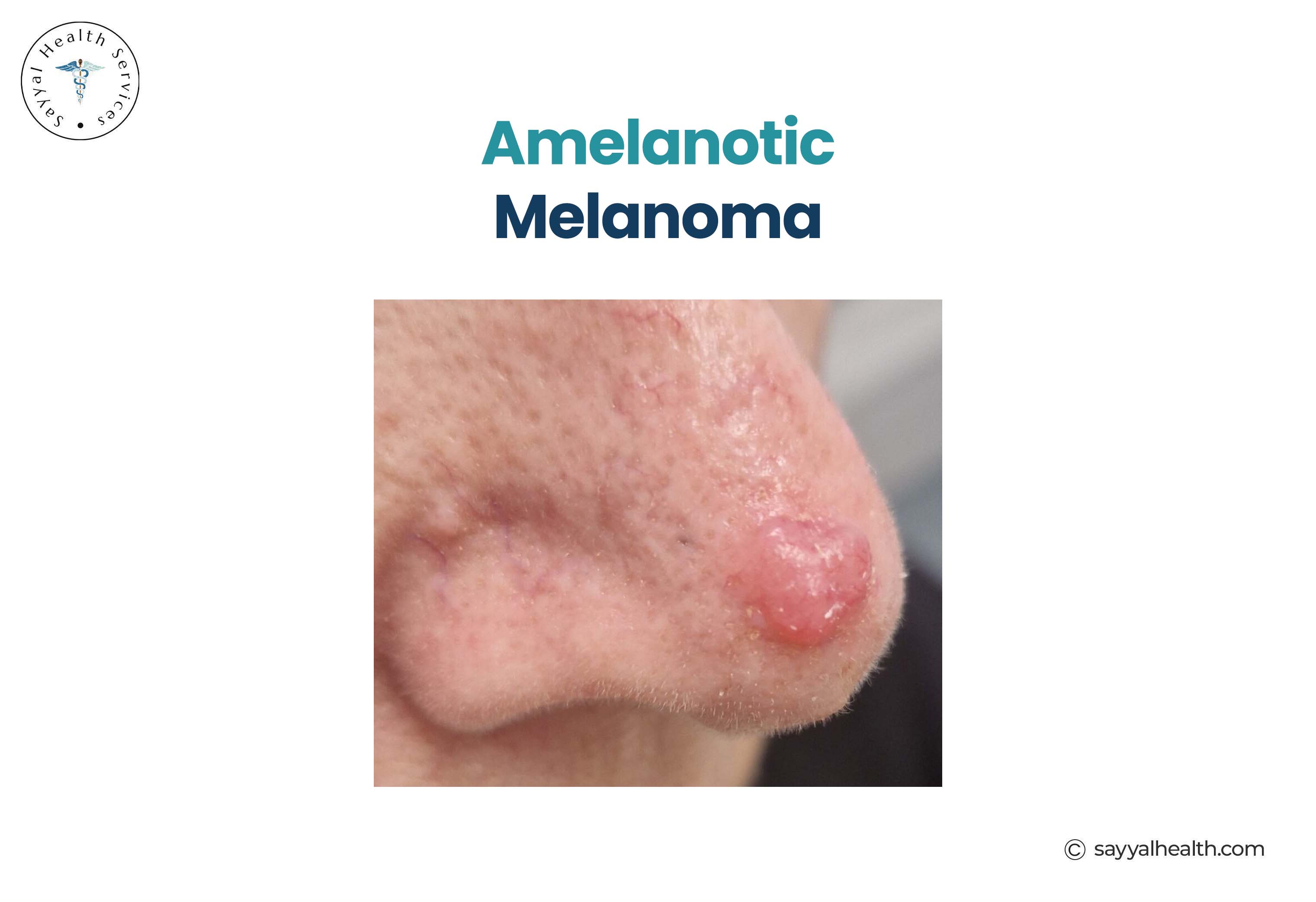 Amelanotic Melanoma Picture